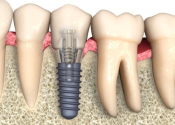 Как устанавливается зуб-имплант