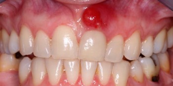 Как удаляется киста на зубе