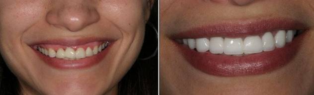 Эффективное отбеливание зубов в клинике эстетической стоматологии КДЦ24