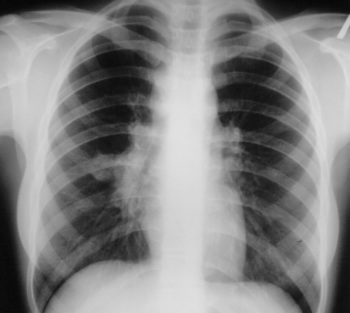Проведение рентгена грудной клетки в КДЦ 24