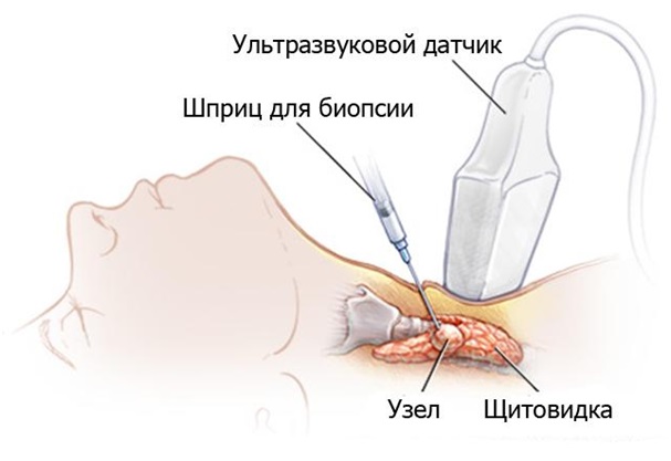 Проведение тонкоигольной аспирационной биопсии узла щитовидной железы