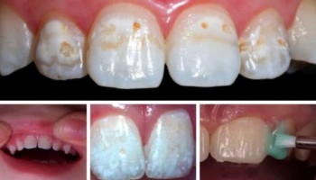 Как происходит фторирование зубов